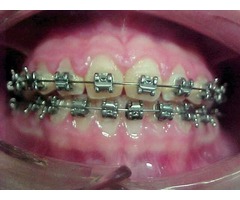 LOS MEJORES BRACKETS Y TE OFRECEMOS HASTA 12 MESES SIN INTERESES