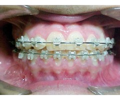 LOS MEJORES BRACKETS Y TE OFRECEMOS HASTA 12 MESES SIN INTERESES